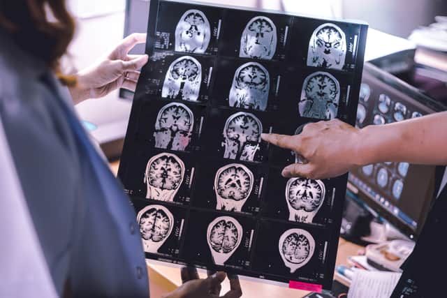 Lecanemab is designed to target and clear a protein called amyloid from patient’s brains (Photo: Adobe)