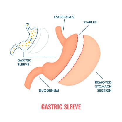 Vertical sleeve gastrectomy.
