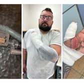 A lorry driver suffered horror injuries when an e-cigarette exploded in his hand.
Mike Calver, 38, was changing the battery on his device at home in Stoke-on-Trent, when it blew up.
His hand, beard and clothes were set on fire - while the scalding e-cigarette stuck to his hand.