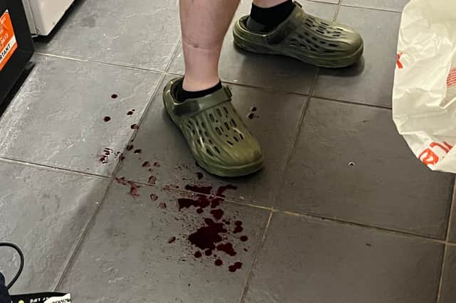 Tom Moss bleeding from the hole in his leg
