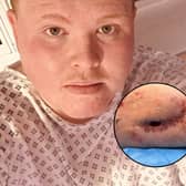 Tom Moss' hole in his leg | Tom Moss / SWNS