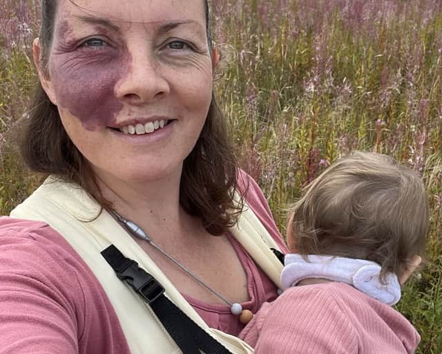 Frith Zerfahs, 44. A mum who wore make-up to "cover up" her birthmark for 20 years says having kids helped her "love" her difference as she didn't want to "hide" from them.