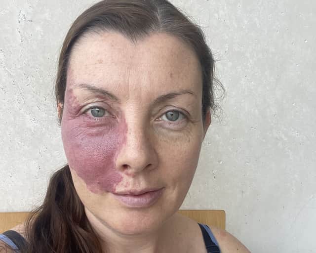Frith Zerfahs, 44. A mum who wore make-up to "cover up" her birthmark for 20 years says having kids helped her "love" her difference as she didn't want to "hide" from them.