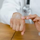 Children with this common skin condition may be more likely to suffer from hay fever later in life.