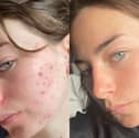 Fight breakouts with 47 Skin and the revolutionary skincare ingredient you’ve properly never heard of 