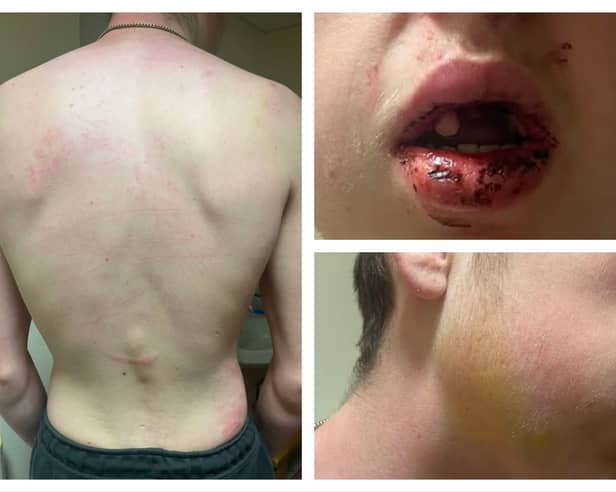 The victim suffered a number of injuries in the attack