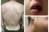 The victim suffered a number of injuries in the attack
