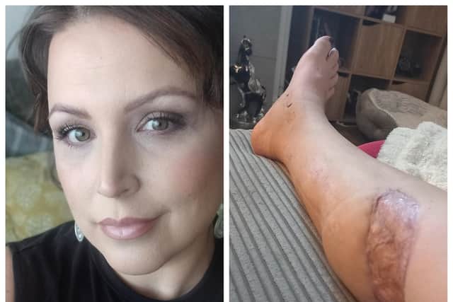 Lauren and her leg after surgery