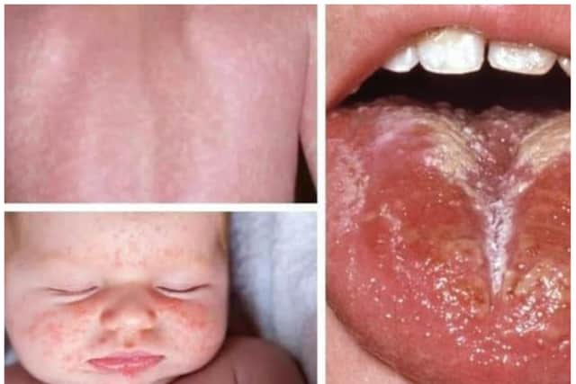 A Strep A case has been found in a Doncaster school.