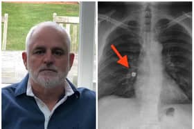 Paul Thorpe had to have emergency surgery after a gold crown got trapped in his lung on a trip to the dentist.