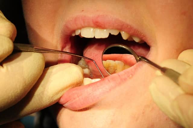 Of those analysed, 38.8 per cent had enamel decay or more serious decay to the layer of dentin under the enamel