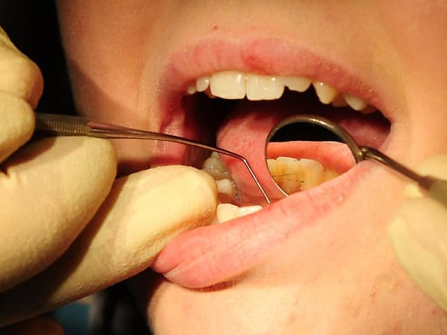 Of those analysed, 38.8 per cent had enamel decay or more serious decay to the layer of dentin under the enamel