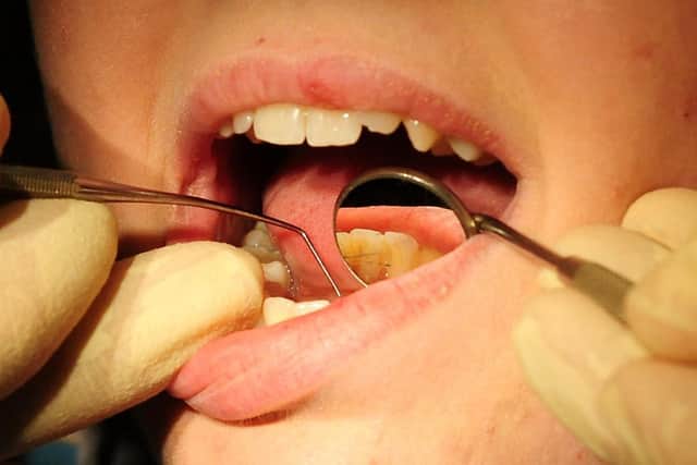 Water fluoridation across South Yorkshire could have a 'huge impact' in stopping children's tooth decay, say public health officers