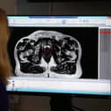 More men diagnosed with prostate cancer in South Yorkshire.