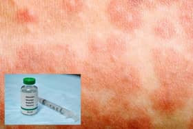 The NHS campaign will see all parents of children aged from six to 11 years contacted encouraging them to make an appointment with their child’s GP practice for their missed MMR vaccine.