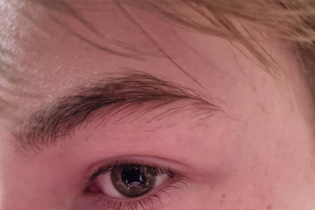 The boy suffered bruising around his eye after the attac