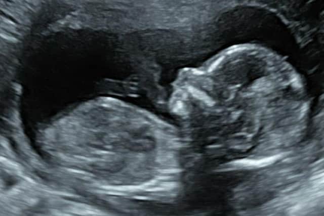 Sonogram of Gracie, due on May 24.