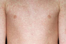 Almost two dozen hospitalised for measles at Doncaster and Bassetlaw Teaching Hospitals Trust.