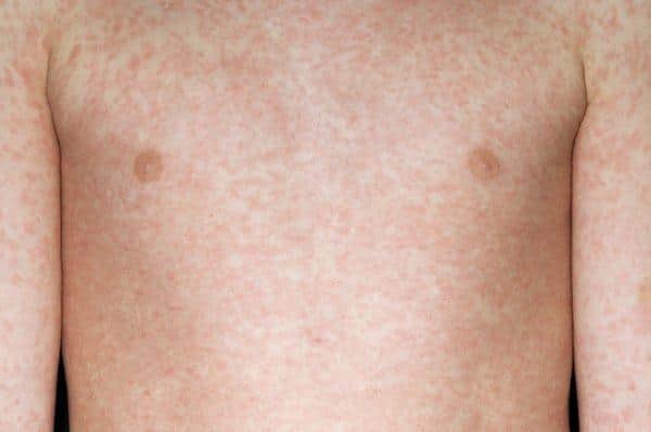 Almost two dozen hospitalised for measles at Doncaster and Bassetlaw Teaching Hospitals Trust.