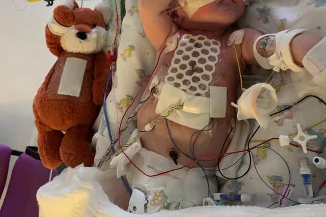 Baby George Clarking after he had open heart surgery at Leeds Hospital aged just 12 days.