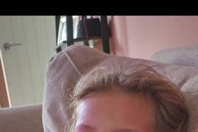 Evie Godden during a flare up of eczema.