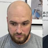 Before and after shows how Hairline Back is pioneering a highly specialised form of medical tattooing to give hair loss sufferers a shaved stubble look