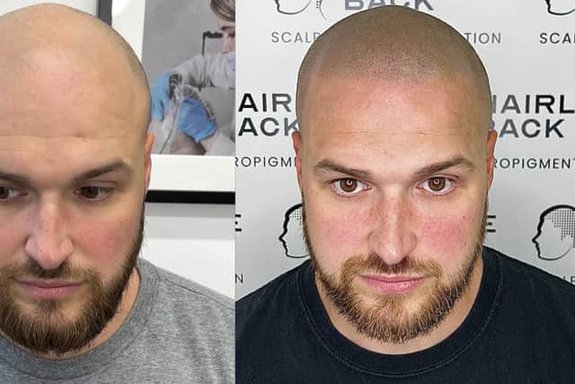 Before and after shows how Hairline Back is pioneering a highly specialised form of medical tattooing to give hair loss sufferers a shaved stubble look