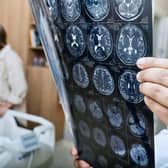 Stroke care