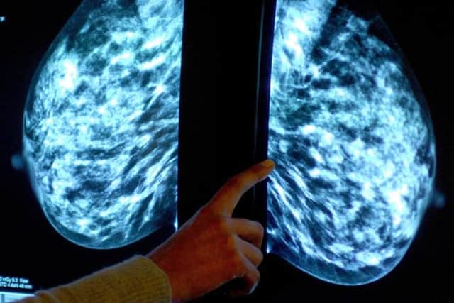 There has been an "alarming" drop in breast cancer screenings