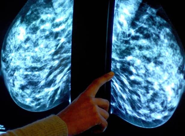 There has been an "alarming" drop in breast cancer screenings