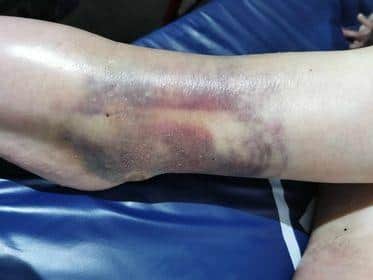 She suffered severe bruising to her ankles and legs.