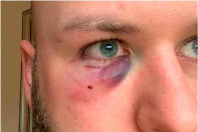 Ryan Hesford suffered facial injuries in the attack.