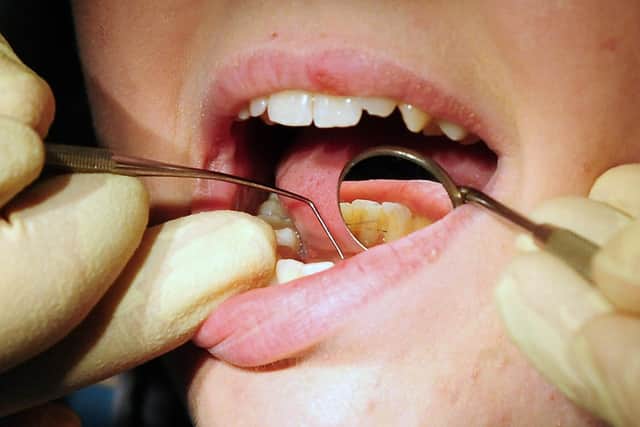 NHS Digital figures show around 595 admissions for children who needed teeth removed