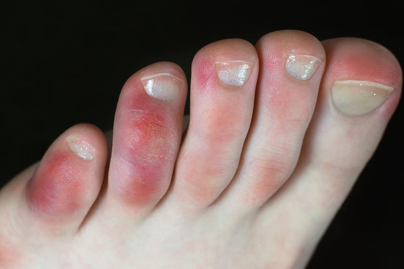 Dubbed ‘Covid fingers and toes’, chilblains is the most significant skin change from a coronavirus infection. It causes red and purple coloured bumps to appear on the fingers, toes and above the palms, and can feel painful in some instances.
