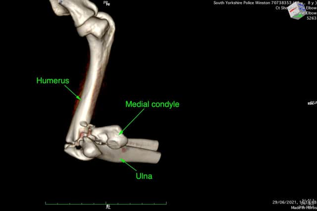 The dramatic X-ray images illustrating the plates and screws needed to repair Police Dog Winston’s fracture to his left foreleg.