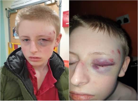 Leo Bates suffered facial injuries in the alleged assault.