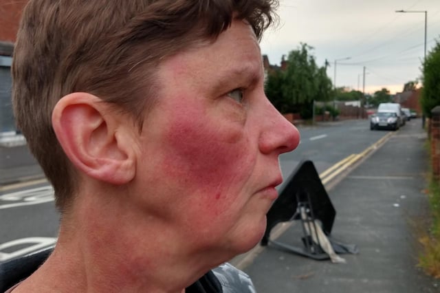 The incident left Alison shaken and bruised