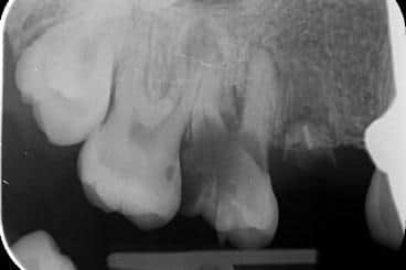 The grossly decayed upper right first molar