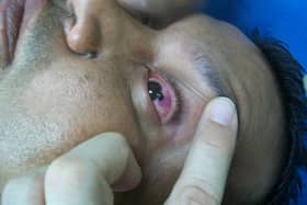 Eye injuries were among those reported