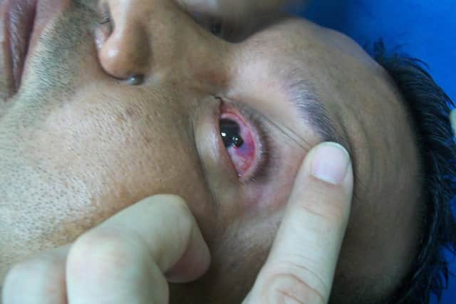Eye injuries were among those reported