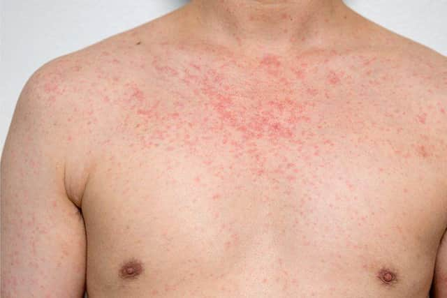 Doctors at DRI are trying to trace patients after a case of measles at the hospital.