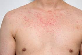 Doctors at DRI are trying to trace patients after a case of measles at the hospital.