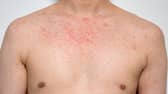 Doctors at DRI are trying to trace patients after a case of measles at the hospital.