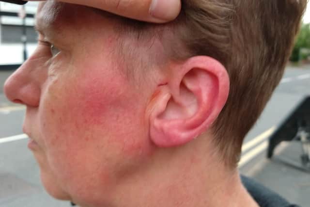 The bruising following the attack