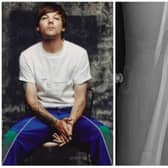Louis Tomlinson has cancelled signings after breaking his arm.