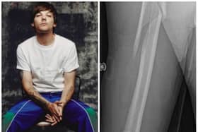 Louis Tomlinson has cancelled signings after breaking his arm.