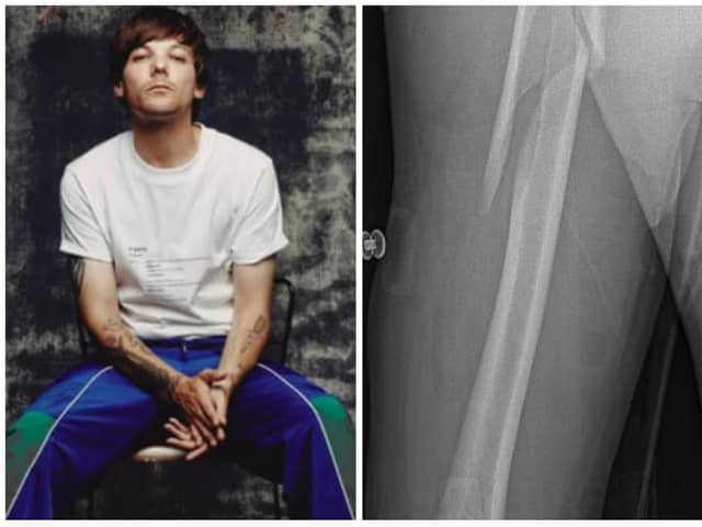 Louis Tomlinson has cancelled signings after breaking his arm.