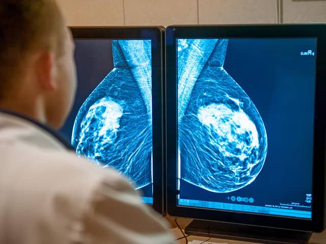 Around 9 in 10 of breast cancers diagnosed through screening are found at an early stage.
