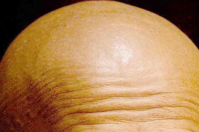 Bald men have less sex - but think they are brilliant in bed.