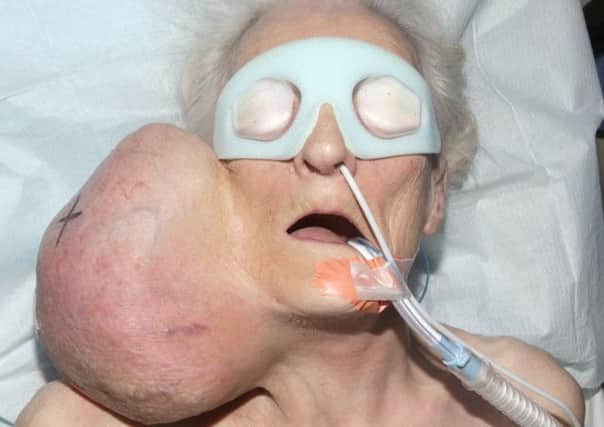 Joyce Haigh, 79, pictured before the 2kg tumour was removed.